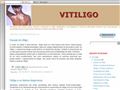 Pormenores : Vitiligo